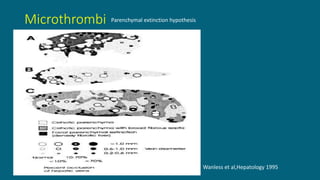Microthrombi
• Parenchymal extinction hypothesis
Parenchymal extinction hypothesis
Wanless et al,Hepatology 1995
 