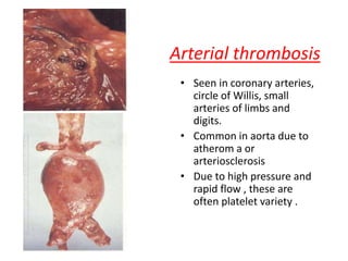Arterial thrombosis
• Seen in coronary arteries,
circle of Willis, small
arteries of limbs and
digits.
• Common in aorta due to
atherom a or
arteriosclerosis
• Due to high pressure and
rapid flow , these are
often platelet variety .
 