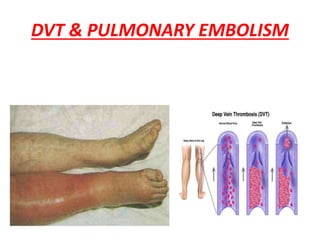 DVT & PULMONARY EMBOLISM
 