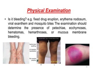 Physical Examination
50
• Is it bleeding? e.g. fixed drug eruption, erythema nodosum,
viral exanthem and mosquito bites The examination should
determine the presence of petechiae, ecchymoses,
hematomas, hemarthroses, or mucous membrane
bleeding.
 