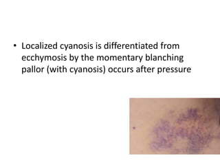 • Localized cyanosis is differentiated from
ecchymosis by the momentary blanching
pallor (with cyanosis) occurs after pressure
 