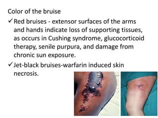 Color of the bruise
Red bruises - extensor surfaces of the arms
and hands indicate loss of supporting tissues,
as occurs in Cushing syndrome, glucocorticoid
therapy, senile purpura, and damage from
chronic sun exposure.
Jet-black bruises-warfarin induced skin
necrosis.
 