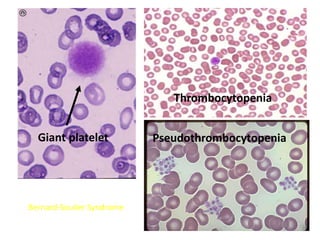 Bernard-Soulier Syndrome
Giant platelet
Thrombocytopenia
Pseudothrombocytopenia
 