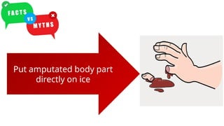 Put amputated body part
directly on ice
Put amputated body part
directly on ice
 
