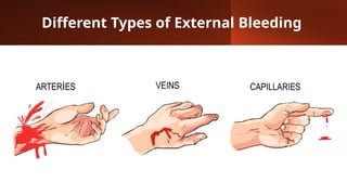 Different Types of External Bleeding
 