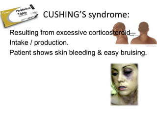 CUSHING’S syndrome:
Resulting from excessive corticosteroid
Intake / production.
Patient shows skin bleeding & easy bruising.
 
