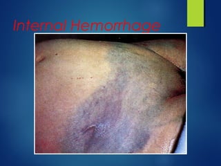 Internal Rupture Bleeding control mit | PPT