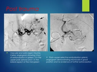 Post trauma
 Vascular and solid organ trauma.
Celiac angiogram showing 3 foci
of extravasation in spleen, 2 in the
upper pole (arrow) and 1 in the
lateral aspect of the mid spleen
 Post—super-selective embolization splenic
angiogram demonstrating microcoils in good
position and no evidence of further extravasation
 
