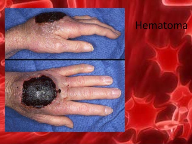 Bleeding diathesis test image