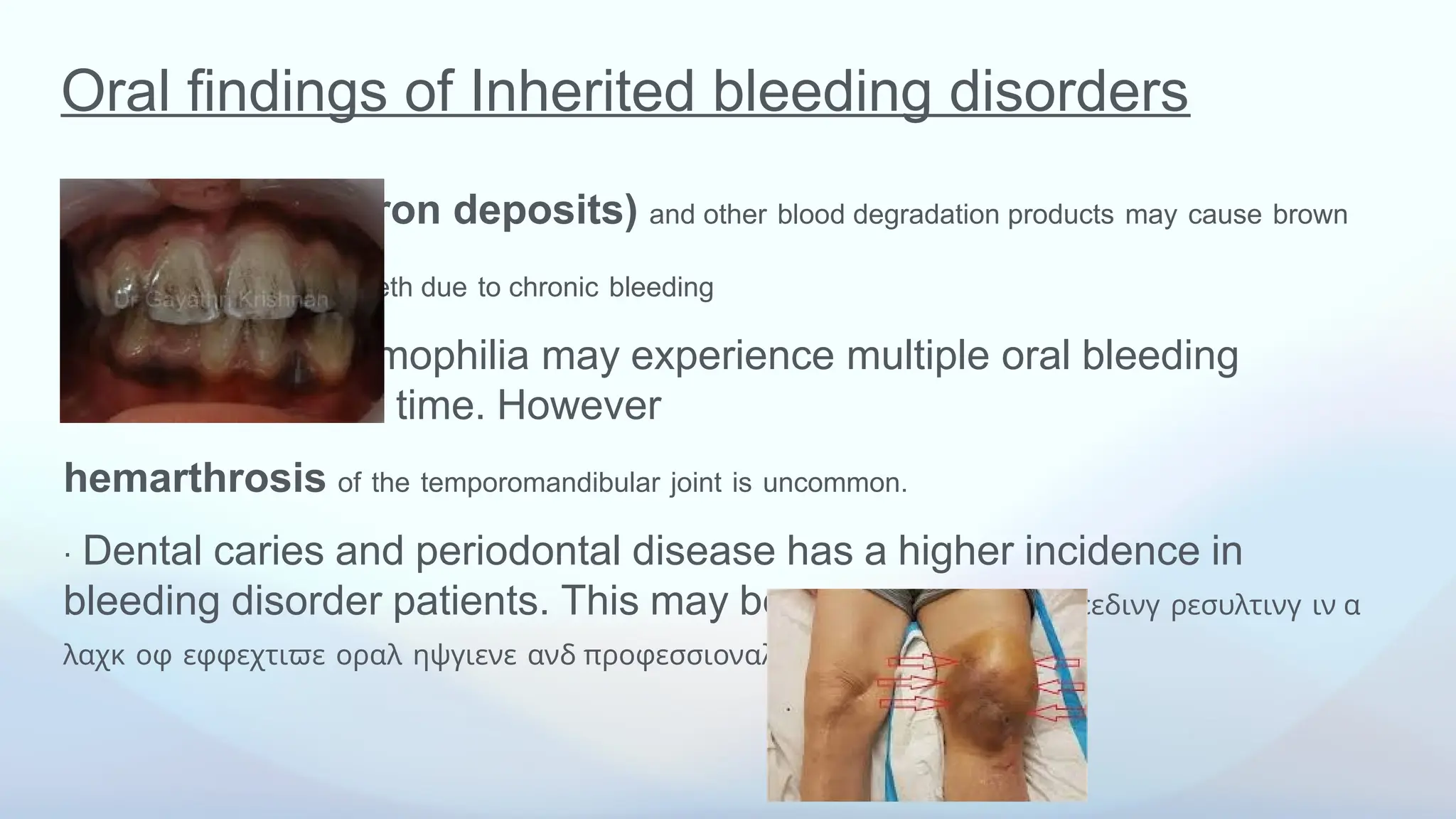 Oral findings of Inherited bleeding disorders
• Hemosiderin (iron deposits) and other blood degradation products may cause brown
deposits on surface of teeth due to chronic bleeding
⋅ Patients with hemophilia may experience multiple oral bleeding
events in their life time. However
hemarthrosis of the temporomandibular joint is uncommon.
⋅ Dental caries and periodontal disease has a higher incidence in
bleeding disorder patients. This may be δυε το α φεαρ οφ βλεεδινγ ρεσυλτινγ ιν α
λαχκ οφ εφφεχτιϖε οραλ ηψγιενε ανδ προφεσσιοναλ χαρε
 