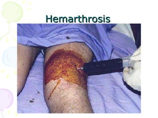 Hemarthrosis 