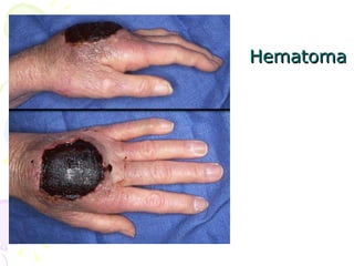 Hematoma 