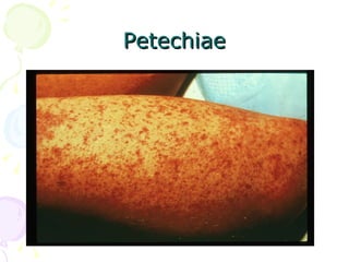 Petechiae 
