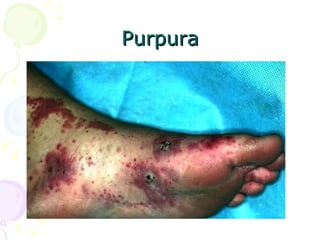 Purpura 
