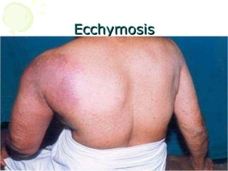 Ecchymosis 