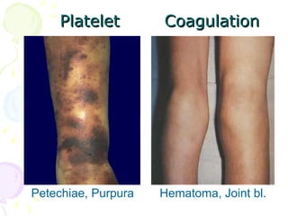 Platelet  Coagulation Petechiae, Purpura   Hematoma, Joint bl. 