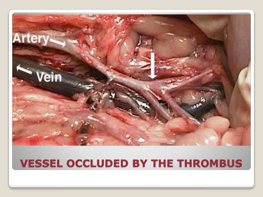Bleeding disorders