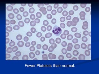 Fewer Platelets than normal.
 
