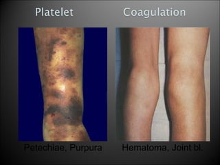 Petechiae, Purpura Hematoma, Joint bl.
24
 