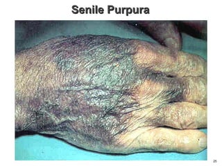 Senile PurpuraSenile Purpura
25
 