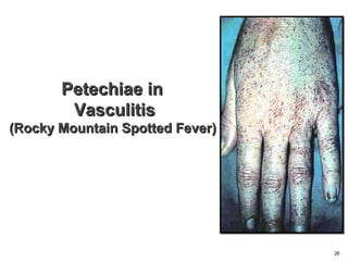 Petechiae inPetechiae in
VasculitisVasculitis
(Rocky Mountain Spotted Fever)(Rocky Mountain Spotted Fever)
26
 