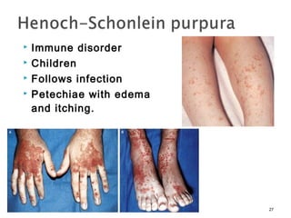  Immune disorder
 Children
 Follows infection
 Petechiae with edema
and itching.
27
 