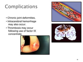 • Chronic joint deformities,
• Intracerebral hemorrhage
may also occur.
• Thrombosis may occur
following use of factor IX
concentrate.
38
 