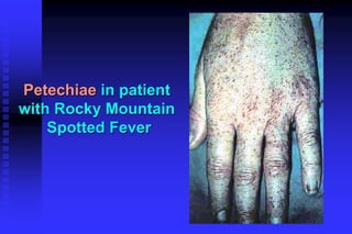 bleeding_disorders.ppt