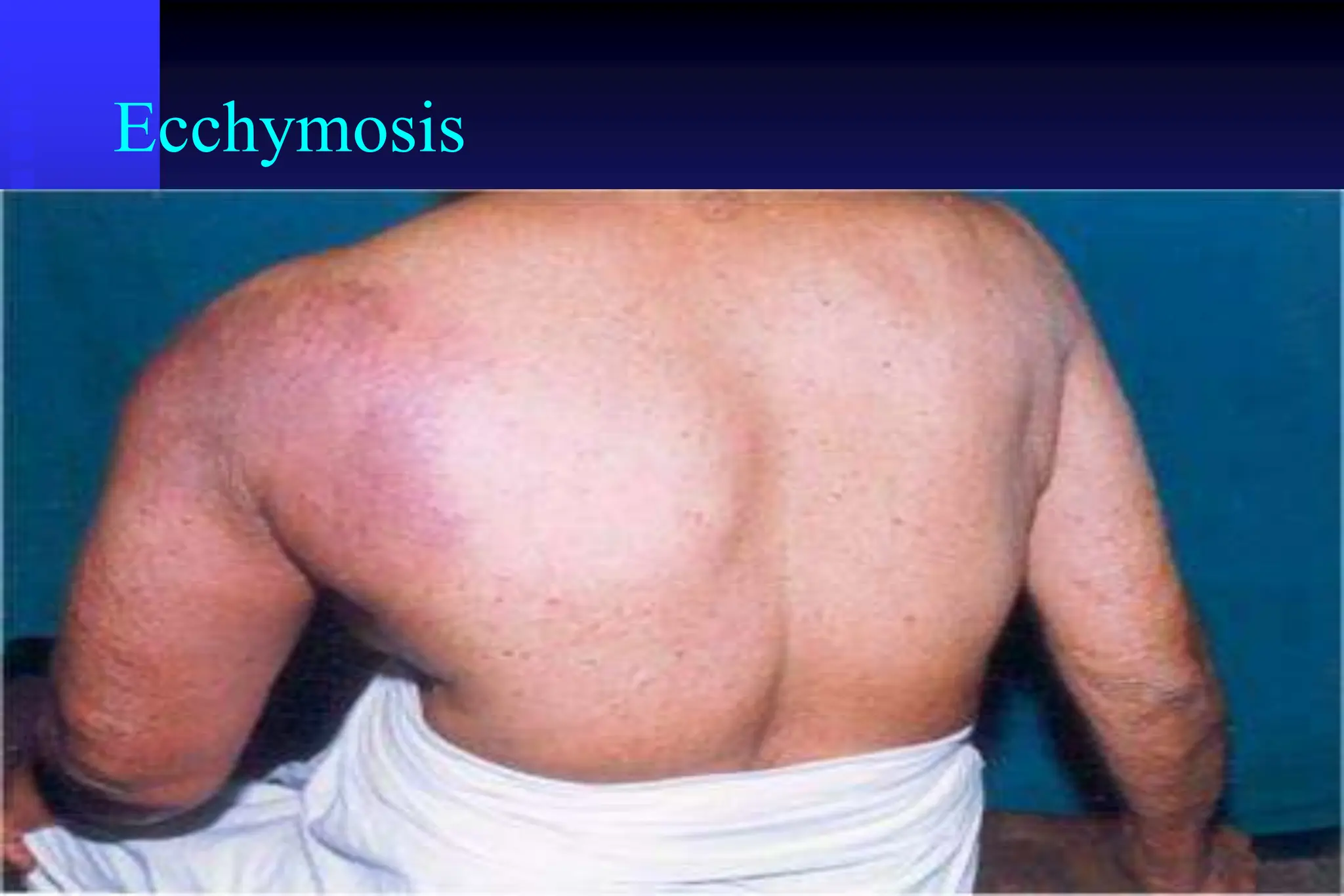 Ecchymosis
 