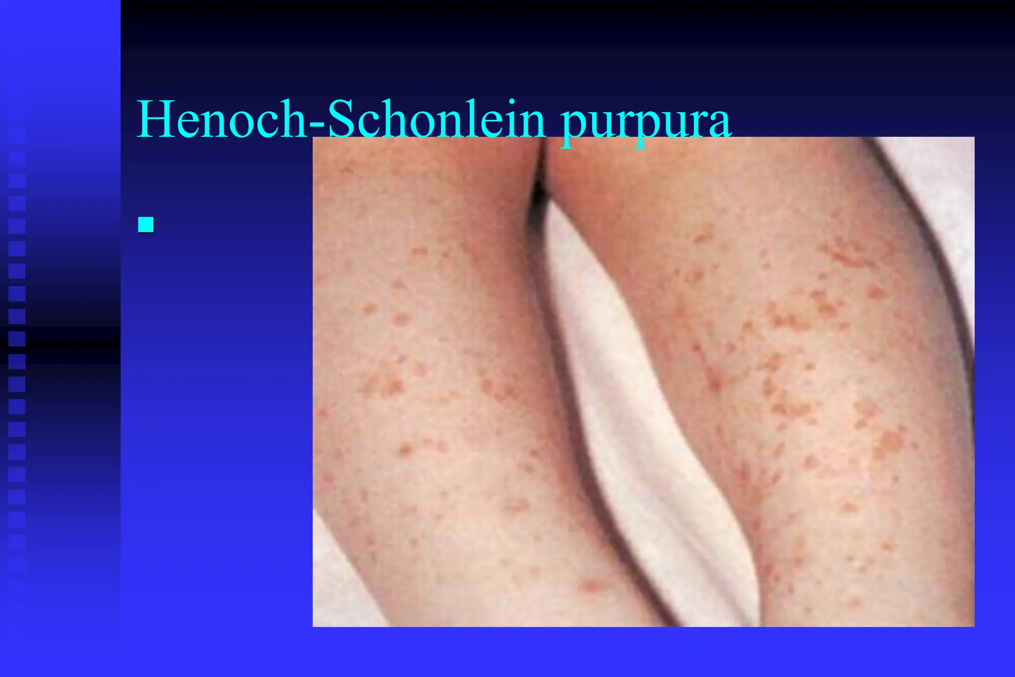 Henoch-Schonlein purpura

 