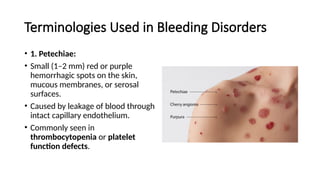 Bleeding Disorders for mbbs mlt mls nursing operation theater ...