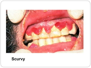 Scurvy
 
