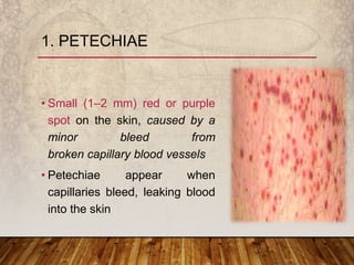 • Small (1–2 mm) red or purple
spot on the skin, caused by a
minor bleed from
broken capillary blood vessels
• Petechiae appear when
capillaries bleed, leaking blood
into the skin
1. PETECHIAE
 