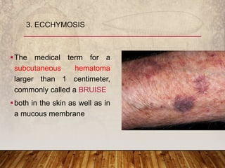 The medical term for a
subcutaneous hematoma
larger than 1 centimeter,
commonly called a BRUISE
both in the skin as well as in
a mucous membrane
3. ECCHYMOSIS
 