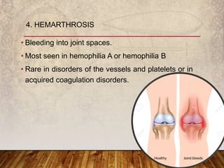 • Bleeding into joint spaces.
• Most seen in hemophilia A or hemophilia B
• Rare in disorders of the vessels and platelets or in
acquired coagulation disorders.
4. HEMARTHROSIS
 