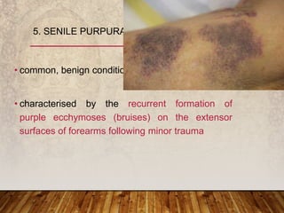 • common, benign condition
• characterised by the recurrent formation of
purple ecchymoses (bruises) on the extensor
surfaces of forearms following minor trauma
5. SENILE PURPURA
 