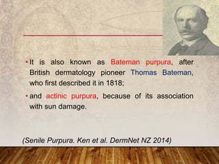 • It is also known as Bateman purpura, after
British dermatology pioneer Thomas Bateman,
who first described it in 1818;
• and actinic purpura, because of its association
with sun damage.
(Senile Purpura. Ken et al. DermNet NZ 2014)
 