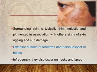 Surrounding skin is typically thin, inelastic and
pigmented in association with others signs of skin
ageing and sun damage.
Extensor surface of forearms and dorsal aspect of
hands
Infrequently, they also occur on necks and faces
 