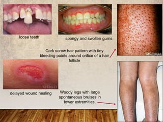 spongy and swollen gumsloose teeth
Cork screw hair pattern with tiny
bleeding points around orifice of a hair
follicle
Woody legs with large
spontaneous bruises in
lower extremities.
delayed wound healing
 