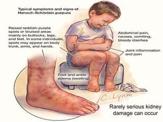 Rarely serious kidney
damage can occur
 