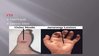CVS
 Osler’s node
 Janeway lesion
 