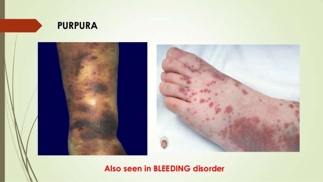 Image result for purpura platelet disorders