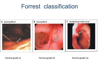 Forrest grade Ia Forrest grade Ib
Forrest classification
Forrest grade IIa
 