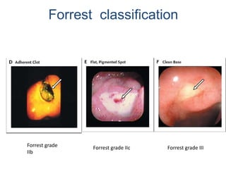 Forrest grade IIc Forrest grade III
Forrest classification
Forrest grade
IIb
 