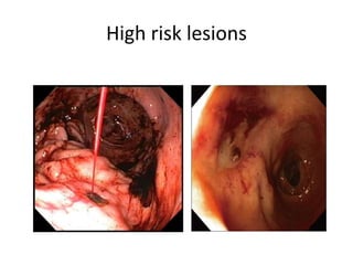 High risk lesions
 