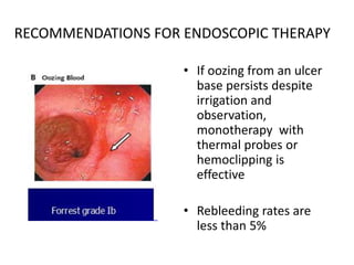 RECOMMENDATIONS FOR ENDOSCOPIC THERAPY
• If oozing from an ulcer
base persists despite
irrigation and
observation,
monotherapy with
thermal probes or
hemoclipping is
effective
• Rebleeding rates are
less than 5%
 