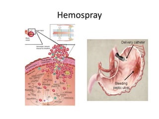 Hemospray
 