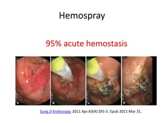 Hemospray
95% acute hemostasis
Sung JJ Endoscopy. 2011 Apr;43(4):291-5. Epub 2011 Mar 31.
 