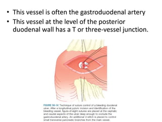 • This vessel is often the gastroduodenal artery
• This vessel at the level of the posterior
duodenal wall has a T or three-vessel junction.
 