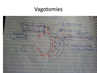 Vagotomies
 
